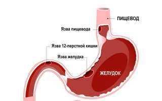 Язва пищевода: симптомы и лечение. Чем лечить язву пищевода: лекарственные препараты и народные средства