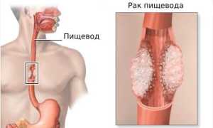 Заболевания пищевода: симптомы и признаки болезни, лечение