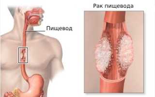 Заболевания пищевода: симптомы и признаки болезни, лечение
