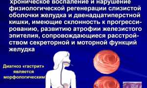 Гастродуоденит: симптомы и лечение у взрослых, препараты и питание