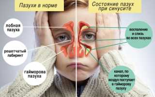 Как лечить синусит у детей?