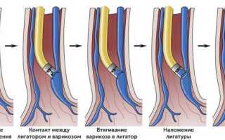 Лигирование вен пищевода при циррозе печени