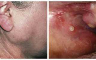 Воспаление слюнных желез или сиалоаденит — симптомы, причины и лечение