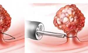 Питание после удаления полипа в желудке эндоскопом и другими способами