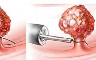 Питание после удаления полипа в желудке эндоскопом и другими способами