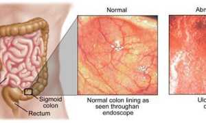 Катаральный колит: симптомы, причины и лечение кишечника