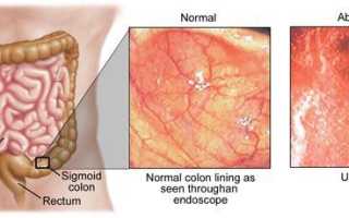 Катаральный колит: симптомы, причины и лечение кишечника