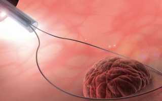 Как удаляют полипы в кишечнике: подготовка к удалению эндоскопическим методом и рекомендации после операции