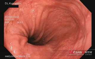 Воспаление пищевода: чем лечить и как?