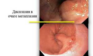 Цилиндроклеточная метаплазия пищевода – что это такое? Симптомы, лечение, прогноз