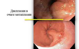 Цилиндроклеточная метаплазия пищевода – что это такое? Симптомы, лечение, прогноз