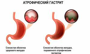 Атрофический гастрит: симптомы и лечение у женщин