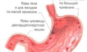 Симптомы язвенной болезни желудка, диагностика, лечение и профилактика