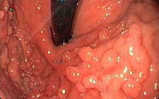 Гиперпластический полип слизистой желудка — что это такое и как лечить?