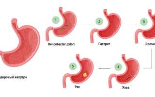 Что такое эрозия антрального отдела желудка: причины, симптомы, лечение