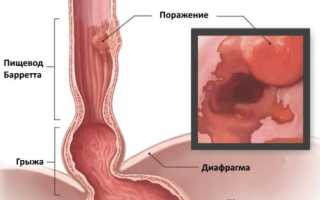 Диагноз пищевод Барретта: симптомы и методы лечения, прогноз на жизнь