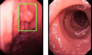 Полипы в желудке: что это такое, как лечить, и опасно ли это?