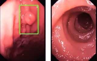 Полипы в желудке: что это такое, как лечить, и опасно ли это?