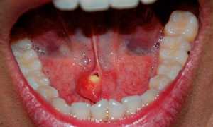 Камни в слюнной железе — основные симптомы, причины и современные способы лечения