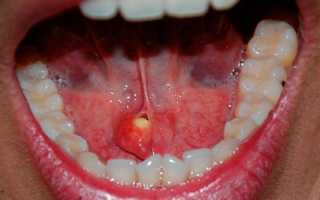 Камни в слюнной железе — основные симптомы, причины и современные способы лечения