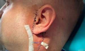 Что такое плеоморфная аденома слюнной железы: насколько это опасно?