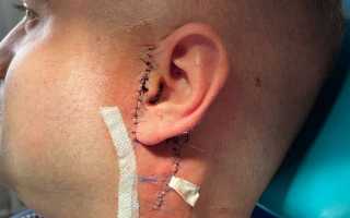 Что такое плеоморфная аденома слюнной железы: насколько это опасно?