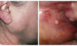 Сиалоаденит околоушной слюнной железы — лечение, виды и симптомы