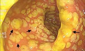 Псевдомембранозный колит