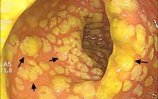 Псевдомембранозный колит
