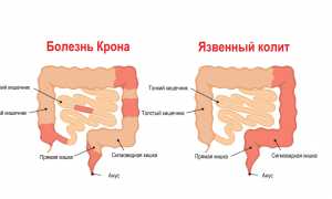 Колит: симптомы и лечение у взрослых