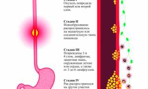 Рак пищевода ранние симптомы и признаки