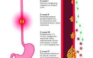 Рак пищевода ранние симптомы и признаки