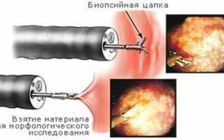 Биопсия желудка: как и для чего делают