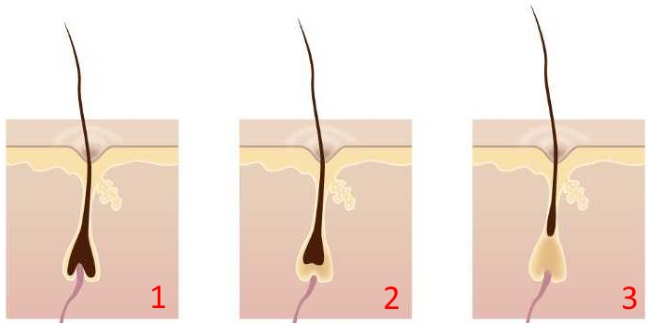 биоэпиляция что это такое