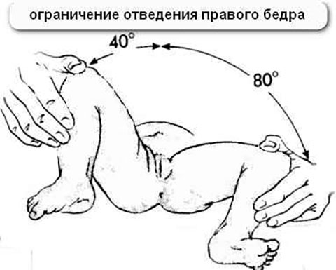ограниченность отведения ножки грудничка