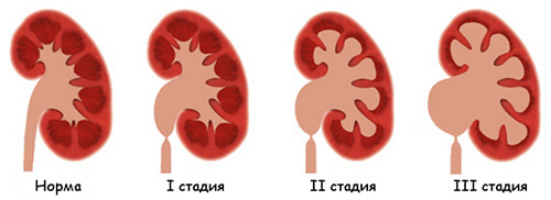 стадии заболевания почек