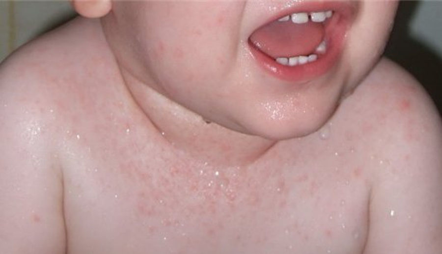 Способы лечения потницы у грудничка