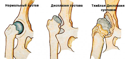 дисплазия у грудничка