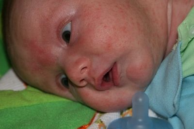 Распознаем и боремся с потницей на лице у грудничка