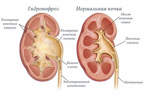 Стоит ли родителям волноваться при увеличении лоханки почки у грудничка? Методы диагностирования заболевания, причины его появления, способы лечения