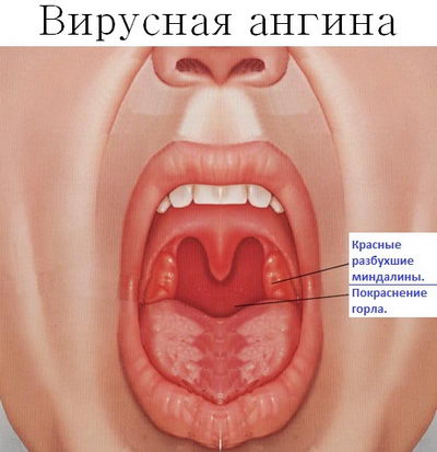 Симптомы вирусной ангины
