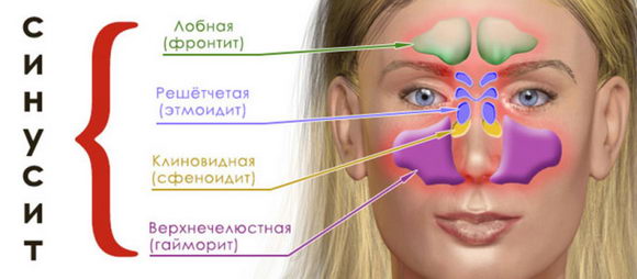 Синусит: классификация