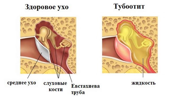 Тубоотит и здоровое ухо