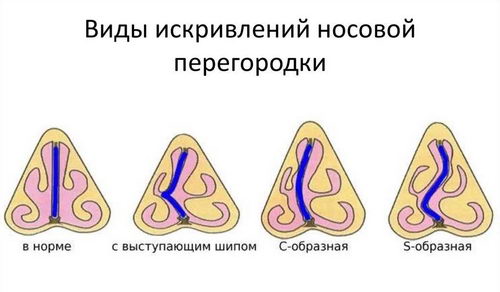 Виды искривления перегородки