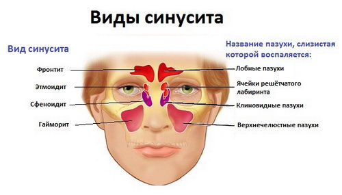 Виды синусита