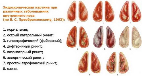 Виды ринита
